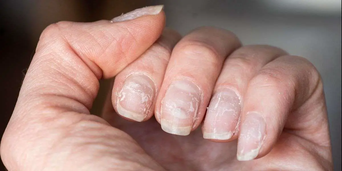Why Are My Nails Peeling?