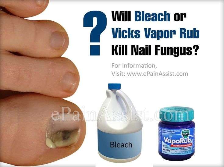 Will Bleach or Vicks Vapor Rub Kill Nail Fungus?