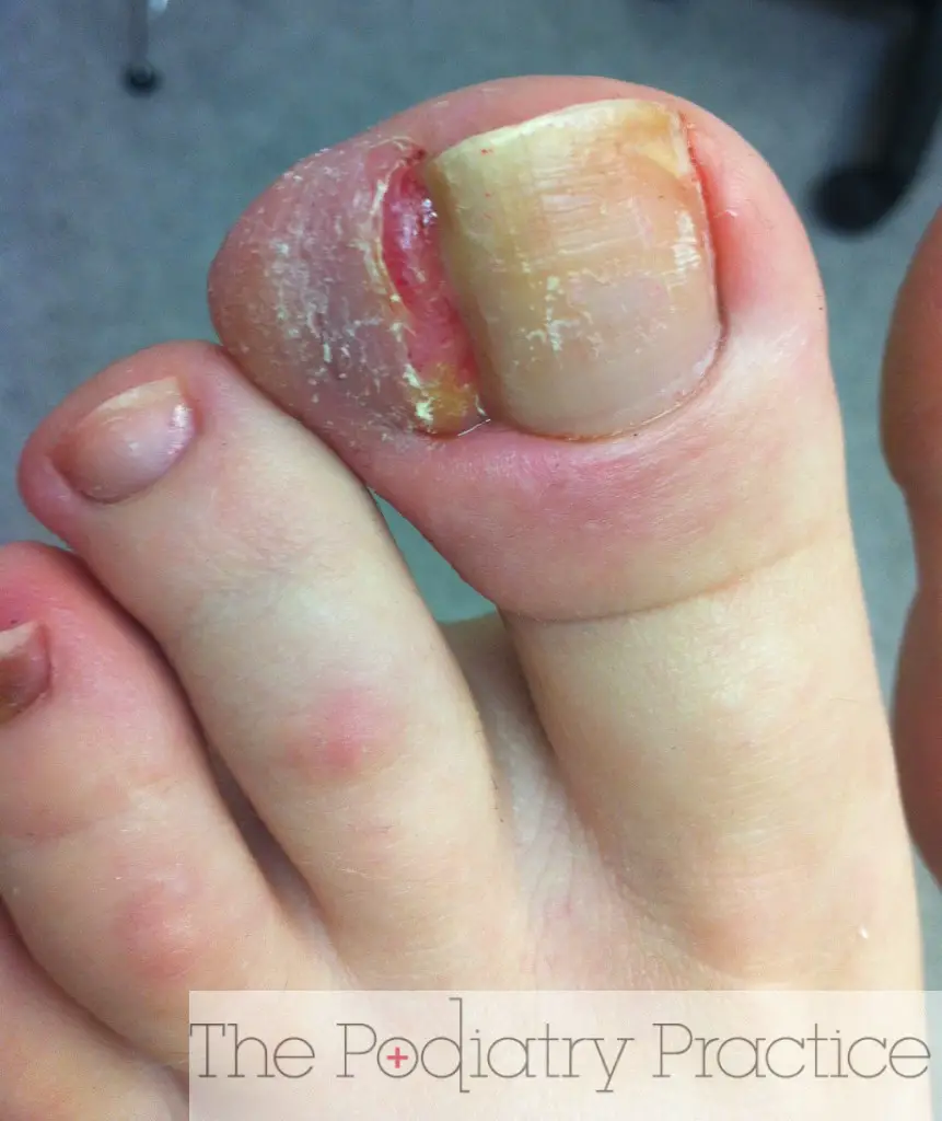 Wow, this is a severe ingrown toenail!